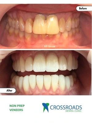 Before and after non prep veneers treatment improving tooth color and shape in Crossroads Dental Clinic Dubai