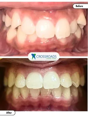 Before and after teeth orthodontic treatment fixing gaps and bite issues with braces in Crossroads Dental Clinic Dubai