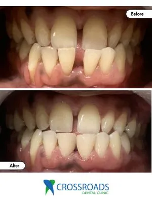 Before and after teeth filling fixing gaps and bite issues in Crossroads Dental Clinic Dubai