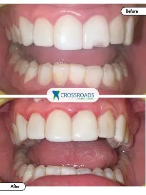 Before and after teeth filling fixing gaps and broken tooth in Crossroads Dental Clinic Dubai