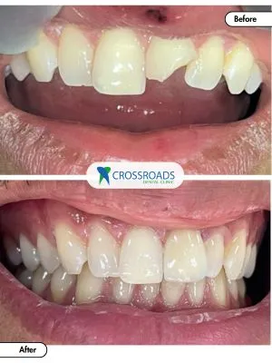 Before and after teeth filling fixing gaps and chipped tooth in Crossroads Dental Clinic Dubai