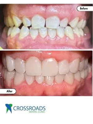 Before and after veneers treatment improving tooth color and shape in Crossroads Dental Clinic Dubai