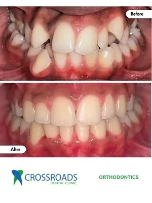 Before and after braces treatment correcting crowded and misaligned teeth in Crossroads Dental Clinic Dubai orthodontic clinic