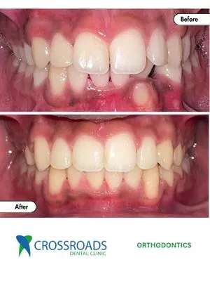 Before and after teeth alignment treatment fixing gaps and bite issues with braces in Crossroads Dental Clinic Dubai