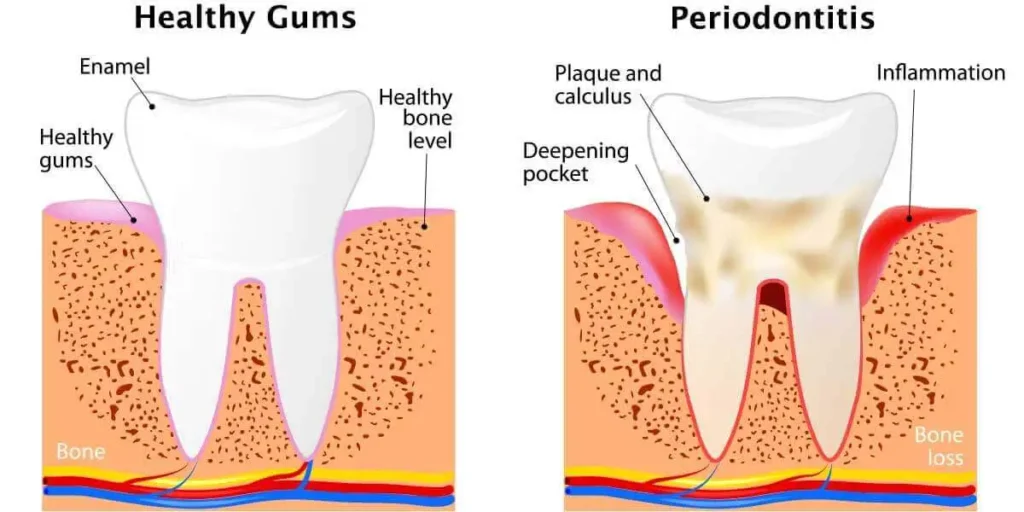 enamel erosion and gum recession diagram