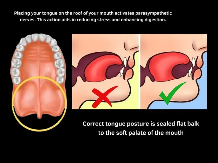 Diagram showing low tongue posture, narrow palate, and crowded teeth caused by mouth breathing