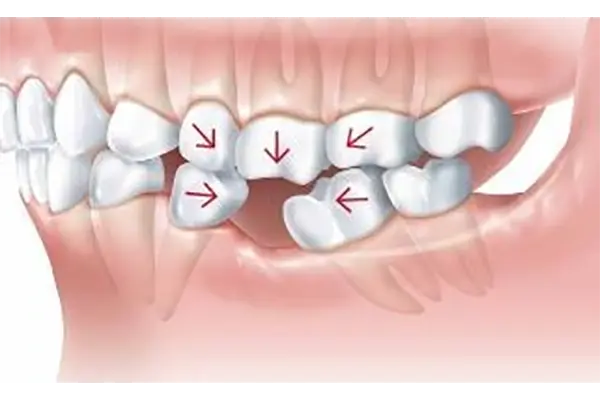 Diagram showing teeth shifting after tooth loss