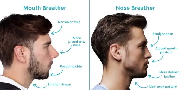 Comparison showing nasal breathing and mouth breathing effects on facial development and oral health