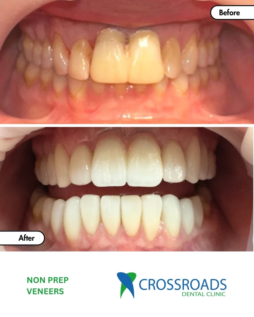 Before and after no-prep veneers, showing brighter teeth and more even tooth shapes at Crossroads Dental Clinic.