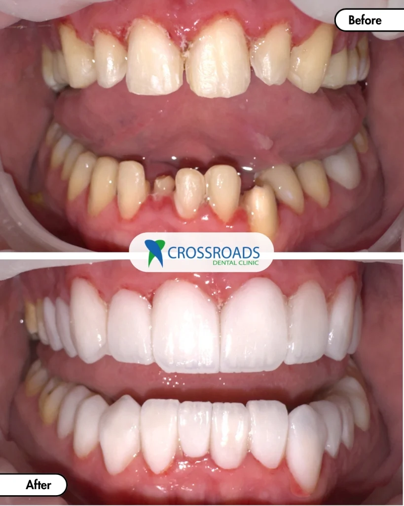 Traditional veneers before and after at Crossroads Dental Clinic, showing brighter front teeth with more even shapes.