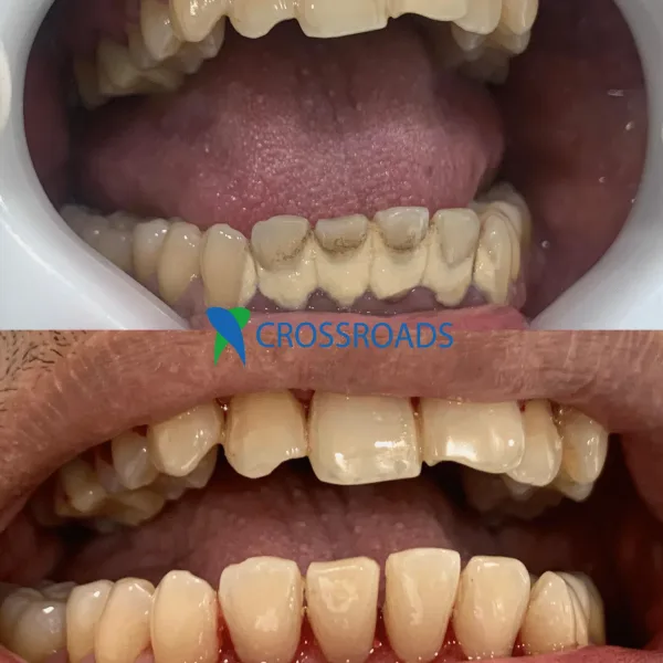 Before and after teeth scaling and polishing at Crossroads Dental Clinic Dubai for cleaner, whiter smile.