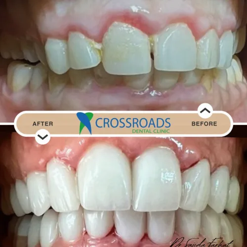 Before and after full mouth rehabilitation at Crossroads Dental Clinic Dubai showing smile makeover and restored teeth on Sheikh Zayed Road and Deira