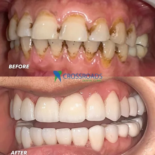 Razio Noor full mouth rehabilitation before and after photo by Crossroads Dental Clinic Dubai showcasing dental restoration, smile makeover, and cosmetic dentistry results.