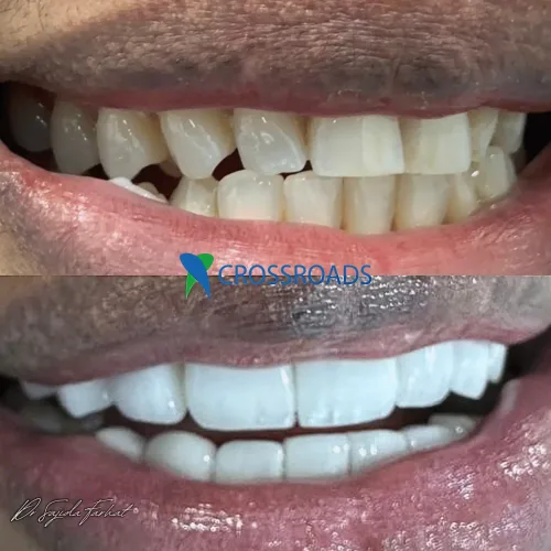 Before and after full mouth rehabilitation at Crossroads Dental Clinic Dubai showing smile makeover and restored teeth on Sheikh Zayed Road and Deira, Dubai