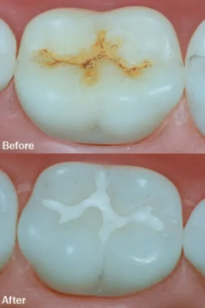 Pit and fissure sealants in Dubai at Crossroads Dental Clinic for cavity prevention